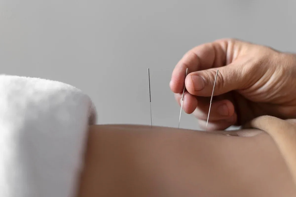Diagnóstico define se acupuntura pode entrar no cuidado da ansiedade