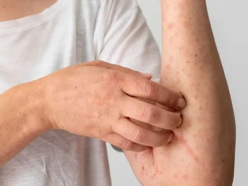 Dermatite atópica pode afetar sono, saúde mental e convivência social