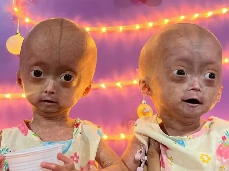 Progéria: doença rara tinha afetado Elis, que morreu aos cinco anos